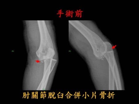 elbow-fx-dislocation (1)
